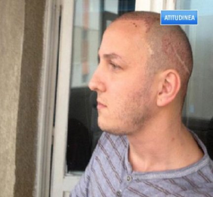 Atitudinea: Asta-i culmea: Mihai Trăistariu nu are voie să facă sex după operaţia de transplant de păr!